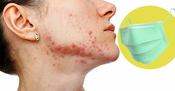 Acne mechania xuất hiện chủ yếu là do sự cọ xát của khẩu trang vào da mặt gây ra. Nguồn ảnh: Palawan News