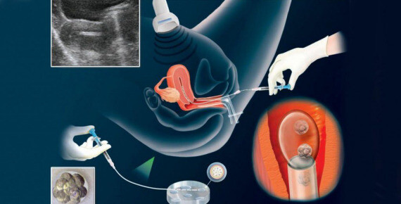 Kỹ thuật chuyển phôi trong phương pháp IVF. Nguồn ảnh: www.mitosis.gr