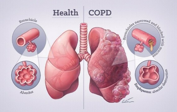 Phổi bình thường và phổi bị COPD (nguồn: https://www.mrinz.ac.nz/)