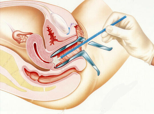 Lấy dịch cổ tử cung để làm xét nghiệm phết tế bào cổ tử cung. Nguồn ảnh: kkspecialityhospital