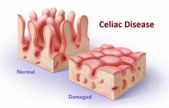 Người mắc bệnh Celiac khi ăn phải Gluten sẽ gây ra những tổn thương cho niêm mạc ruột non.   Nguồn ảnh: celebrity.fm