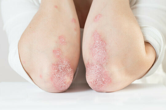 Are Triggers Causing Your Psoriasis Flare-Ups - Dermatology Physicians  Group Chicago Illinois