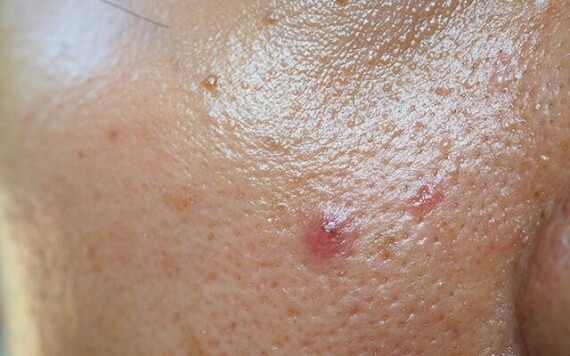Làn da dầu là một trong những nguyên nhân góp phần dẫn đến viêm da tiết bã trên mặt. Nguồn: vedix.com