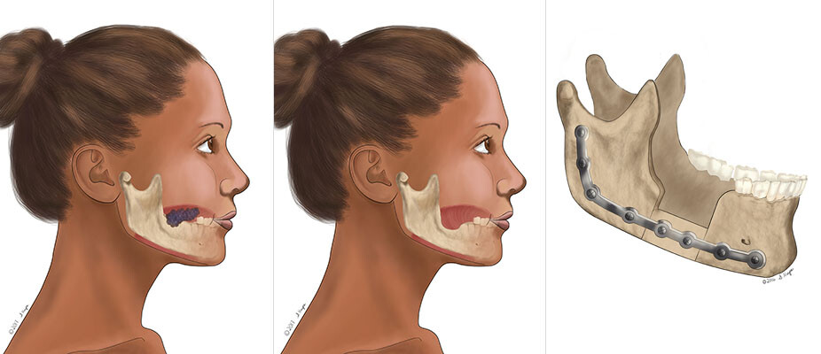 Hình ảnh minh họa cắt và tái tạo xương hàm ( Nguồn ảnh từ hospital.uillinois.edu)