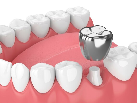 Silver Tooth Crowns | Benefits, Treatment, Side Effects & CostChụp răng giả bằng kim loại. Nguồn ảnh: Hovedentalclinic.com