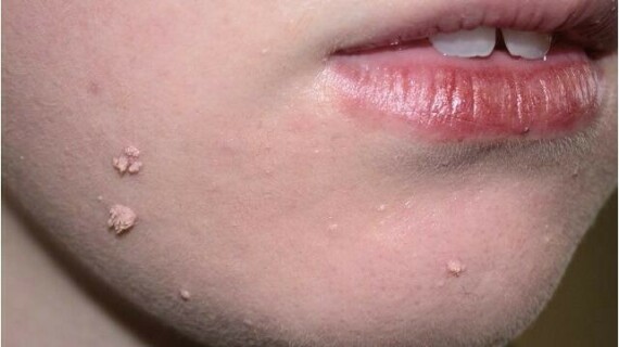 Skin Tags on Lips: Causes and TreatmentMụn cóc dạng sợi mọc trên mặt. Nguồn: https://www.healthline.com 