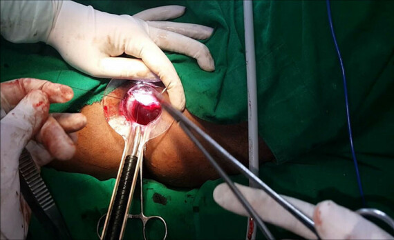 Phẫu thuật cắt bũi trĩ ( Nguồn Vietmec group)