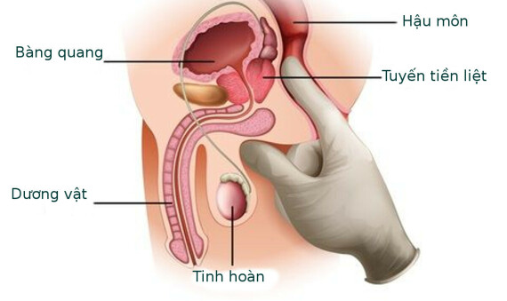 Khám tuyến tiền liệt qua đường trực tràng