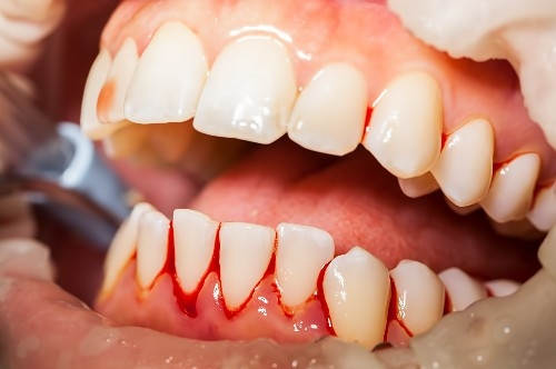Chảy máu lợi răng khi đánh răng, dùng chỉ nha khoa hoặc khi ăn khi bị viêm lợi. (nguồn: signaturesmilesmi.com)