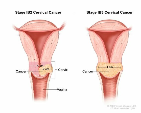 Giai đoạn IB2 và IB3 ung thư cổ tử cung. Trong giai đoạn IB2, ung thư lớn hơn 2 cm nhưng không lớn hơn 4 cm. Trong giai đoạn IB3, ung thư lớn hơn 4 cm.