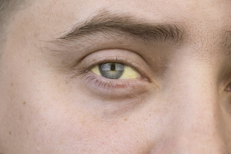 Người bị ung thư gan giai đoạn tiến triển có thể bị vàng da và vàng mắt. Nguồn ảnh: Healthcentral.com