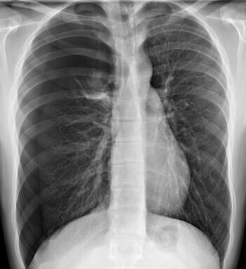 Ảnh chụp X quang tràn khí màng phổi áp lực. Nguồn: msdmanuals.com