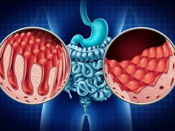 Celiac là bệnh lý tự miễn gây phá hủy, bào mòn các vi nhưng mao trên bề mặt niêm mạc ruột.   Nguồn ảnh: Healthline