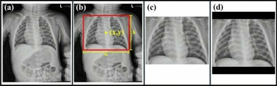 X-quang phổi. Nguồn wikipedia.com
