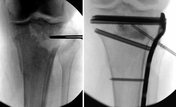 Gãy xương bị trũng (hình bên trái) phải được nâng cao trở lại để phục hồi khớp. Điều này làm giảm nguy cơ viêm khớp và bất ổn. Khi các mảnh khớp bị lõm được nâng lên, một lỗ thường vẫn còn bên dưới (hình bên phải). Điều này có thể được lấp đầy bằng nhiều loại xương ghép, vật liệu tổng hợp hoặc tự nhiên.