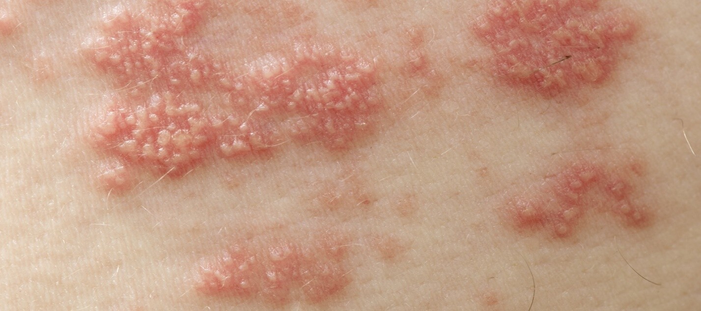 Tổn thương da trong bệnh zona. Nguồn ảnh: irishtimes
