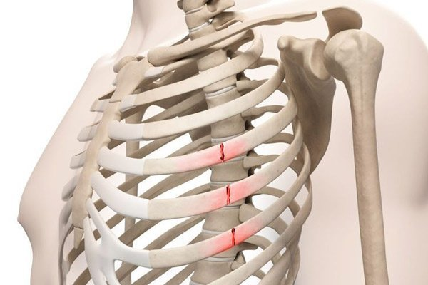Làm thế nào để xác định vị trí chính xác của xương sườn số 5 trong cơ thể?