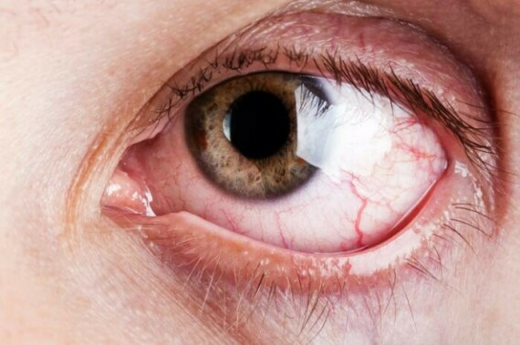 Phấn trang điểm, kem dưỡng da và các sản phẩm khác khi sử dụng quanh mắt có thể gây ngứa và kích ứng (nguồn ảnh: Pinterest)