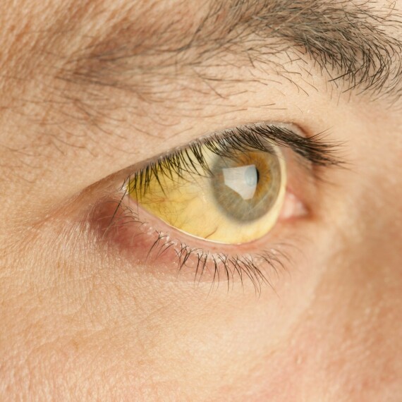 ​Vàng da, vàng mắt là dấu hiệu dễ nhận biết của tăng bilirubin máu. Nguồn ảnh: Verywellhealth.com