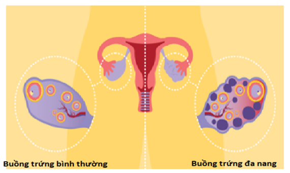 Hình minh họa buồng trứng bình thường và buồng trứng đa nang (nguồn: https://healthcare.utah.edu)