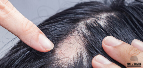 Rụng tóc thành từng mảng nhỏ trên da đầu, thường có kích thước vài cm hoặc ít hơn. (nguồn: smpofaustin.com)
