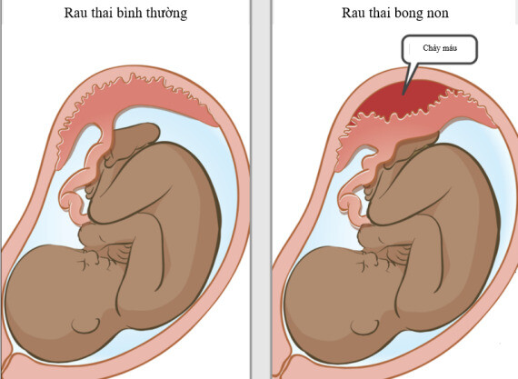  Rau bong non là một tình trạng có thể dẫn tới thai chết lưu (https://www.aboutkidshealth.ca/)