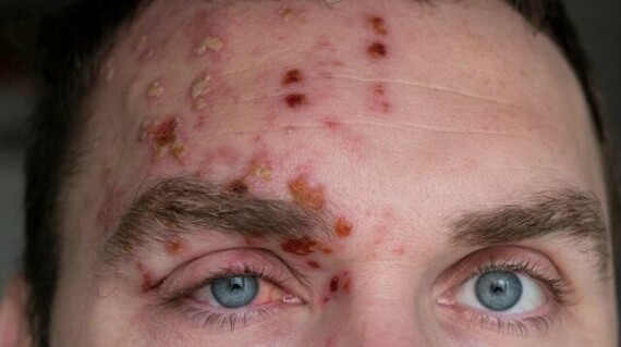 “Giời leo” xuất hiện quanh mắt là một tình trạng nghiêm trọng cần tư vấn từ bác sĩ mắt. Nguồn ảnh: medicalnewstoday.com