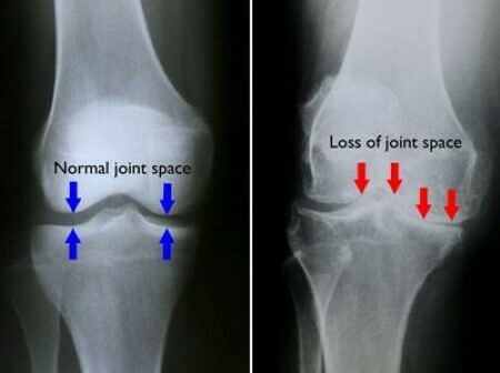 (Trái) Trong hình chụp X-quang đầu gối bình thường này, khoảng trống giữa các xương cho thấy sụn khỏe mạnh (mũi tên). (Phải) Hình chụp x-quang khớp gối này cho thấy tình trạng mất không gian khớp nghiêm trọng.