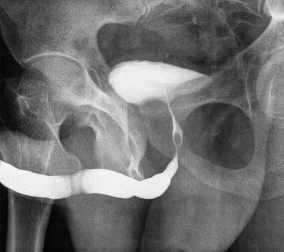 Chụp niệu đạo ngược dòng. Nguồn ảnh: radiopaedia