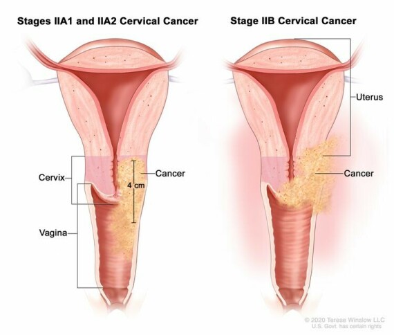 Giai đoạn II ung thư cổ tử cung. Trong giai đoạn IIA1 và IIA2, ung thư đã lan từ cổ tử cung đến 2/3 phía trên của âm đạo nhưng chưa lan đến các mô xung quanh tử cung. Ở giai đoạn IIA1, ung thư có kích thước 4 cm hoặc nhỏ hơn. Trong giai đoạn IIA2, ung thư lớn hơn 4 cm. Trong giai đoạn IIB, ung thư đã lan từ cổ tử cung đến các mô xung quanh tử cung.