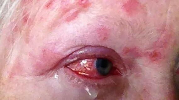 Zona thần kinh gây ảnh hưởng nghiêm trọng tới mắt và vùng da xung quanh. Nguồn ảnh: medicalnewstoday.com