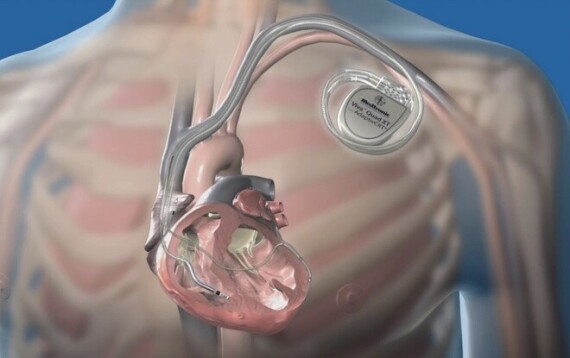 Máy khử rung tim (ICD - Implantable cardioverter-defibrillator) (Nguồn: https://www.dicardiology.com/)