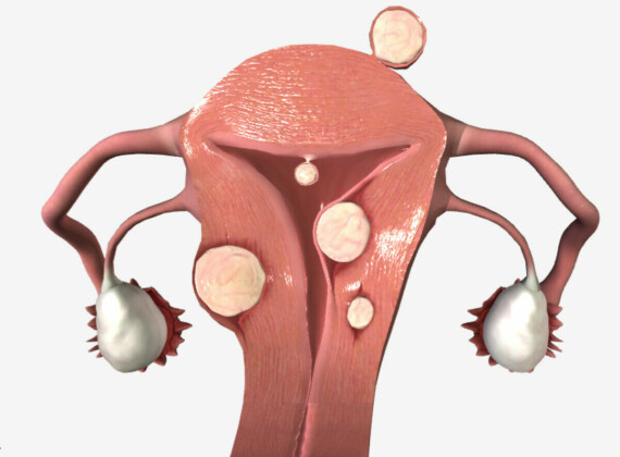 Uterine Leiomyoma and Leiomyosarcoma | Concise Medical KnowledgeU xơ tử cung (Nguồn ảnh: Lecturio.com)