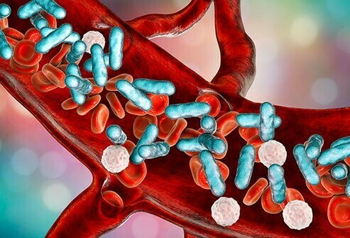 Virus cúm có thể trực tiếp hoặc gián tiếp gây ra nhiễm trùng huyết qua nhiễm trùng thứ phát, gây đe dọa tính mạng người bệnh. Nguồn ảnh: medicinenet.com