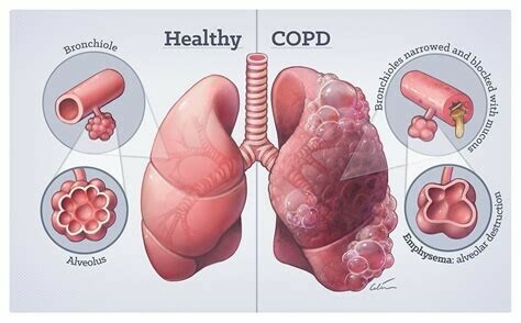 Hình ảnh giải phẫu bệnh COPD : Lòng phế nang giãn rộng mất tính đàn hồi, các tiểu phế quản- phế quản viêm, tăng tiết nhầy, và tăng sinh tổ chức xơ gây hẹp đường dẫn khí. Nguồn ảnh : Pinterest