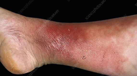 Bệnh viêm quầng do liên cầu gây ra ở vùng cẳng chân. Nguồn ảnh: sciencephoto.com