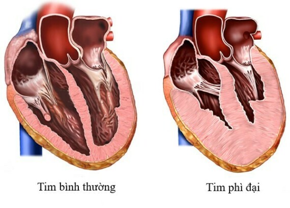 Suy tim là một nguyên nhân hay gặp gây phù phổi cấp, nguồn ảnh rwjbh.org
