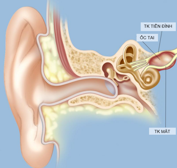 Minh họa về vị trí của u dây thần kinh số VIII, có thể gây chèn ép các dây thần kinh khác nhau. (Nguồn ảnh: weillcornellbrainandspine.org)