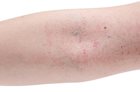 Quá liều Plavix có thể gây xuất huyết dưới da. Nguồn ảnh: freewebstore.org