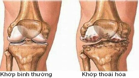 Thoái hóa khớp thường gây ra hiện tượng xương cọ xát vào xương. Gai xương là đặc điểm chung của dạng viêm khớp này.