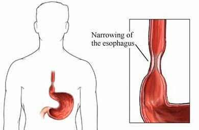 Tình trạng hẹp thực quản là một tình trạng nghiêm trọng cần can thiệp y tế. Nguồn ảnh: cancercare.com