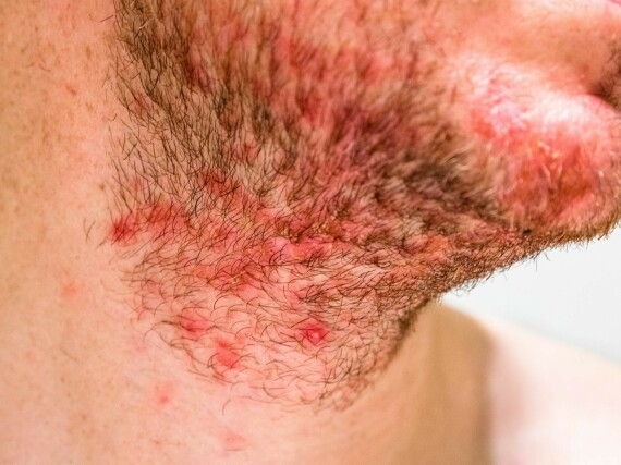 Trên mặt, viêm da tiết bã thường gặp ở những nơi có nhiều lông. Nguồn: verywellhealth.com