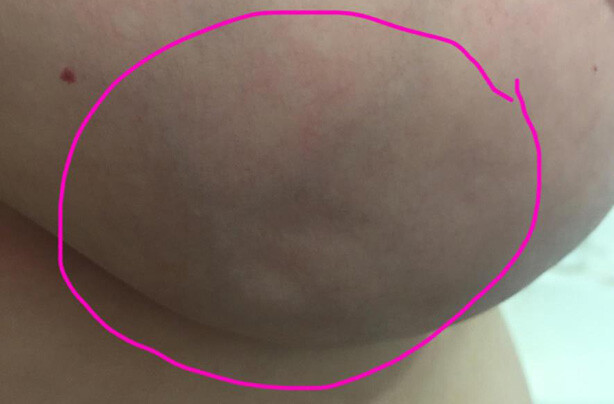 Triệu chứng lõm da( vùng khoanh tròn màu tím) trong bệnh ung thư vú(nguồn ảnh: https://www.goodto.com/)