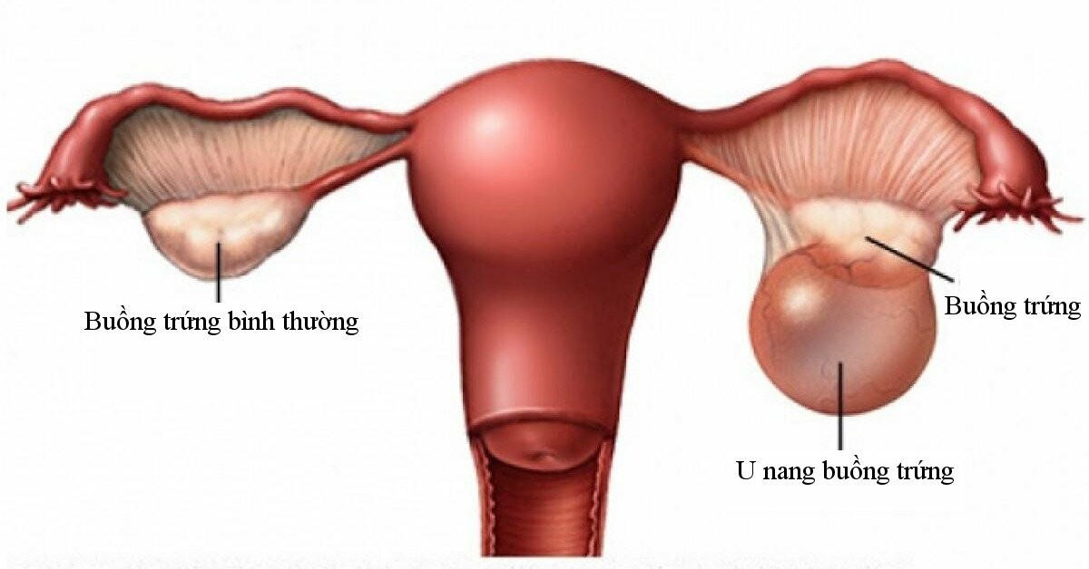 U nang buồng trứng có thể đạt tới đường kính xấp xỉ 50cm – Nguồn ảnh: mayoclinic.org