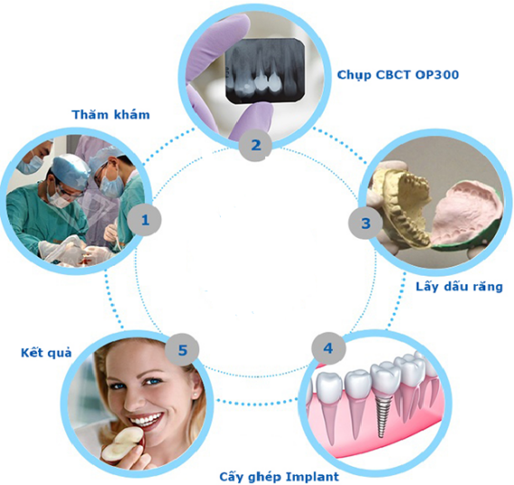 Quy trình cấy ghép răng Implant - Nha Khoa Tâm Sài Gòn