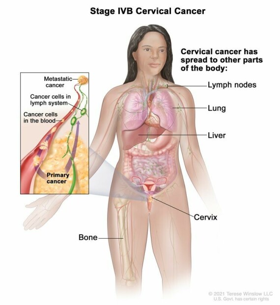 Giai đoạn IVB ung thư cổ tử cung. Ung thư đã lan đến các bộ phận khác của cơ thể, chẳng hạn như các hạch bạch huyết, phổi, gan hoặc xương.