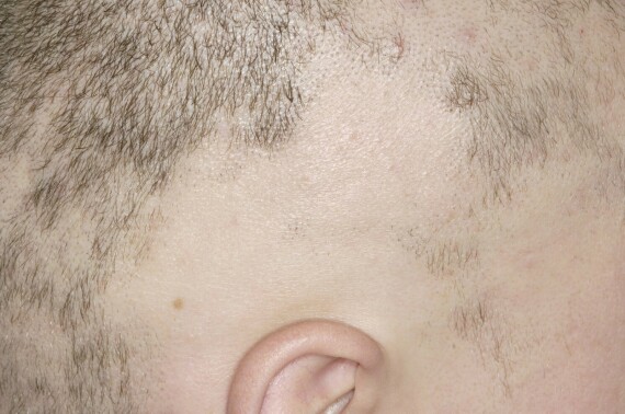 Rụng tóc từng mảng có các vết hói loang lổ trên đầu, nguyên nhân do hệ thống miễn dịch tấn công và phá hủy nang tóc. (nguồn: babycenter.com)