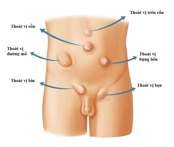 Thoát vị thành bụng – Nguồn ảnh: thesurgeonscollective.com.au