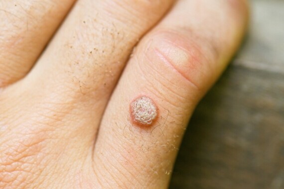 Mụn cóc là những nốt sần trên da do vi rút u nhú gây ra – Nguồn ảnh: hagerstownderm.com