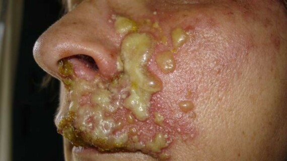Giai đoạn vi-rút varicella-zoster dễ lây lan. Nguồn ảnh: medicalnewstoday.com